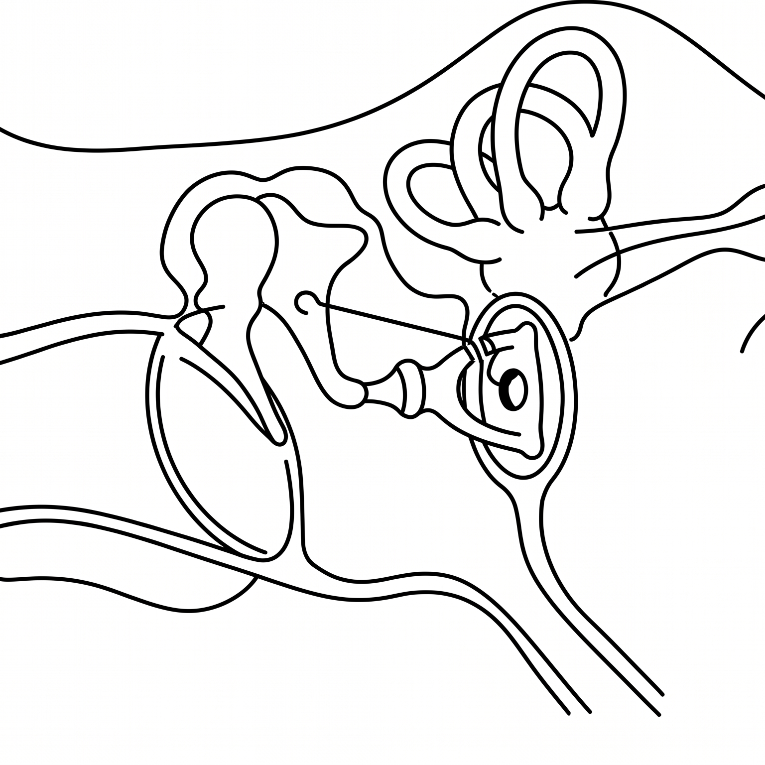 Stapedotomy — Otosclerosis
