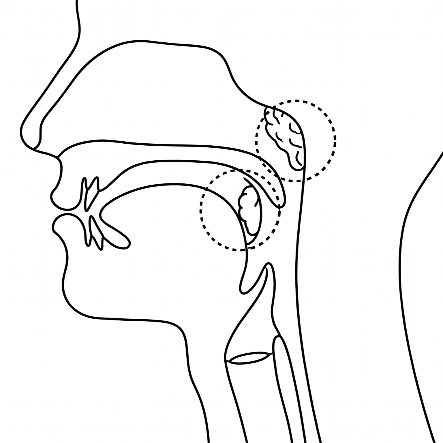 Coblation Tonsillectomy